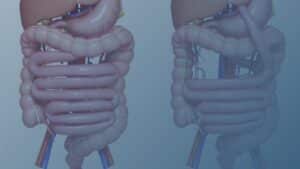 Ilustração comparativa de dois tipos de cirurgia bariátrica: à esquerda, o estômago e intestino normais; à direita, a técnica de bypass gástrico, com uma parte do estômago isolada e o intestino reencaminhado.